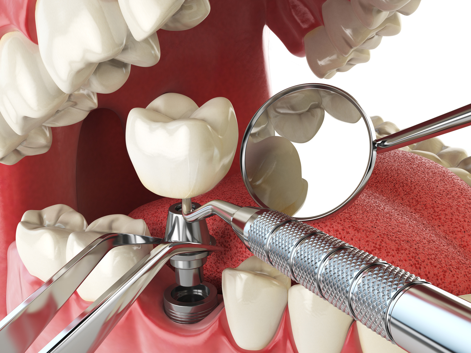 implanty zębów w częstochowie